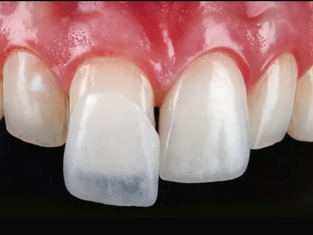 Carillas estéticas y coronas de zirconio en el Consultorio Odontológico Santa María
