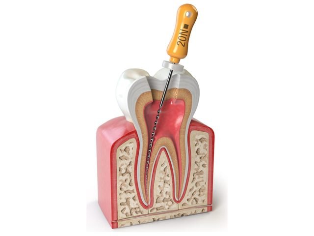 Endodoncia en el Consultorio Odontológico Santa María