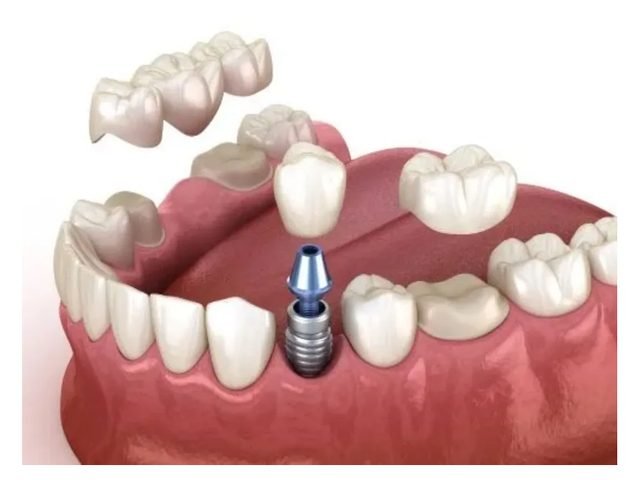 Implantes en el Consultorio Odontológico Santa María
